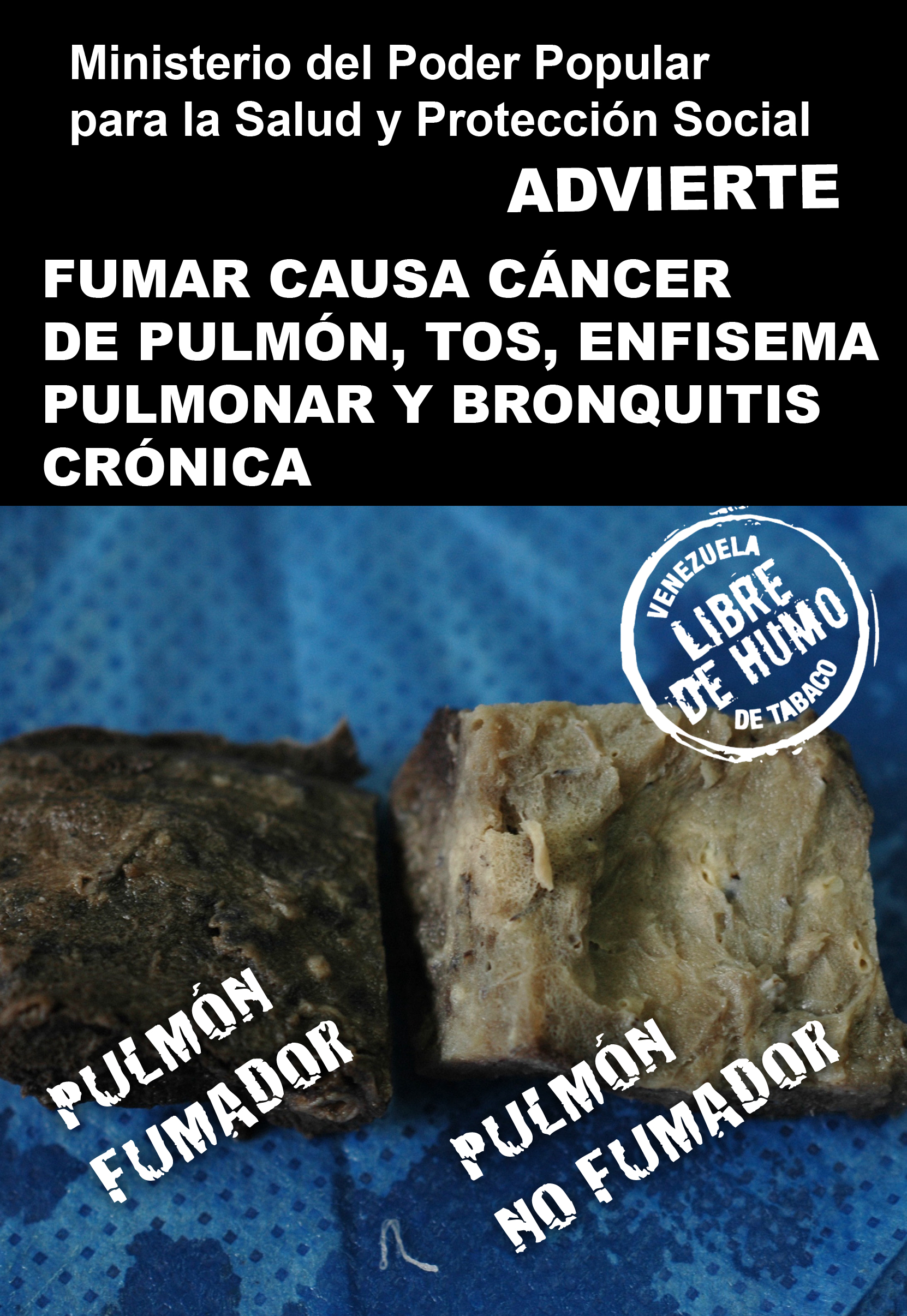 Venezuela 2009 Health Effects lung - comparison of smoker and non-smoker lung, lung cancer